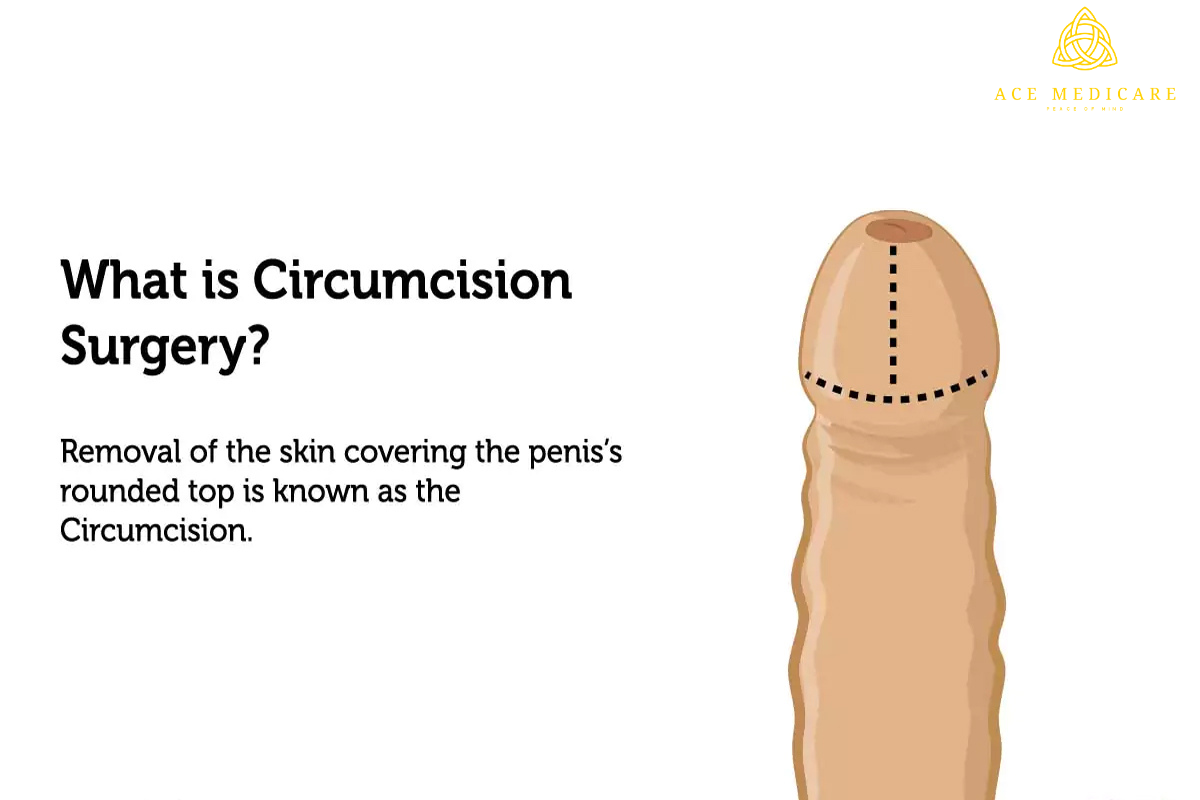 The Health Benefits of Circumcision and Khatna: Debunking Myths